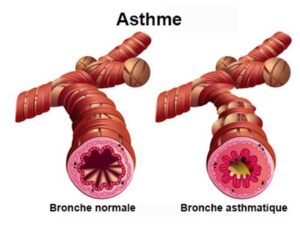 Solution Naturelle contre L'Asthme