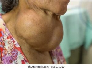Goitre Diagnostic Traitement Naturel