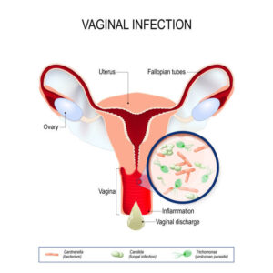 Vaginite Causes Symptômes Prévention Solution Naturelle contre la Vaginite
