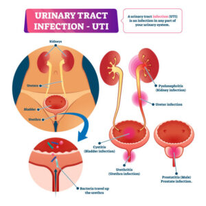 Infection Urinaire Causes Symptômes Prévention Solution Naturelle