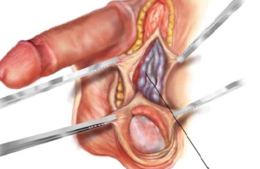 Varicocèle Testiculaire Causes Symptômes Traitement Naturel