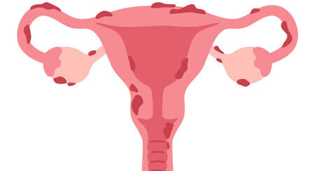 Endométriose Causes Conséquents Traitement Naturel de l'Endométriose