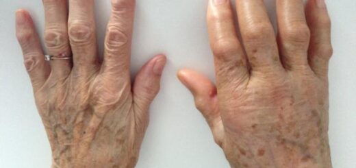 Algodystrophie Causes Symptômes Traitement Naturel de l' Algodystrophie