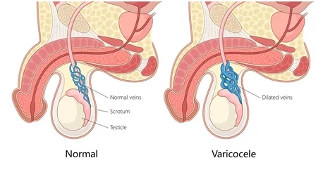 Comment Traiter Naturellement la Varicocèle Bilatérale de Grade 3 ?