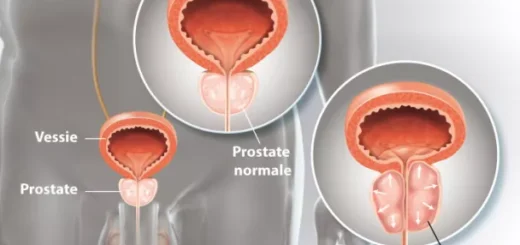Comment Traiter Naturellement l' Adénome de la Prostate avec les Plantes ?