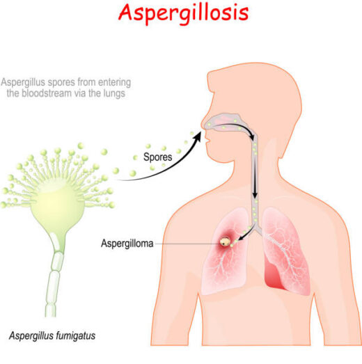 Comment Soigner Naturellement l' Aspergillose Par les Plantes Médicinales ?